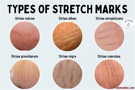 Do Guys Care About Stretch Marks? And Why Do We Even Bother Asking?