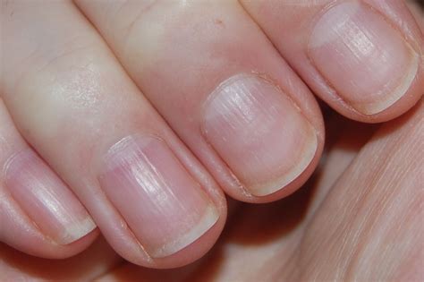 How Should Health Care Workers Keep Their Fingernails? And Why Do They Sometimes Resemble Tiny Masterpieces?